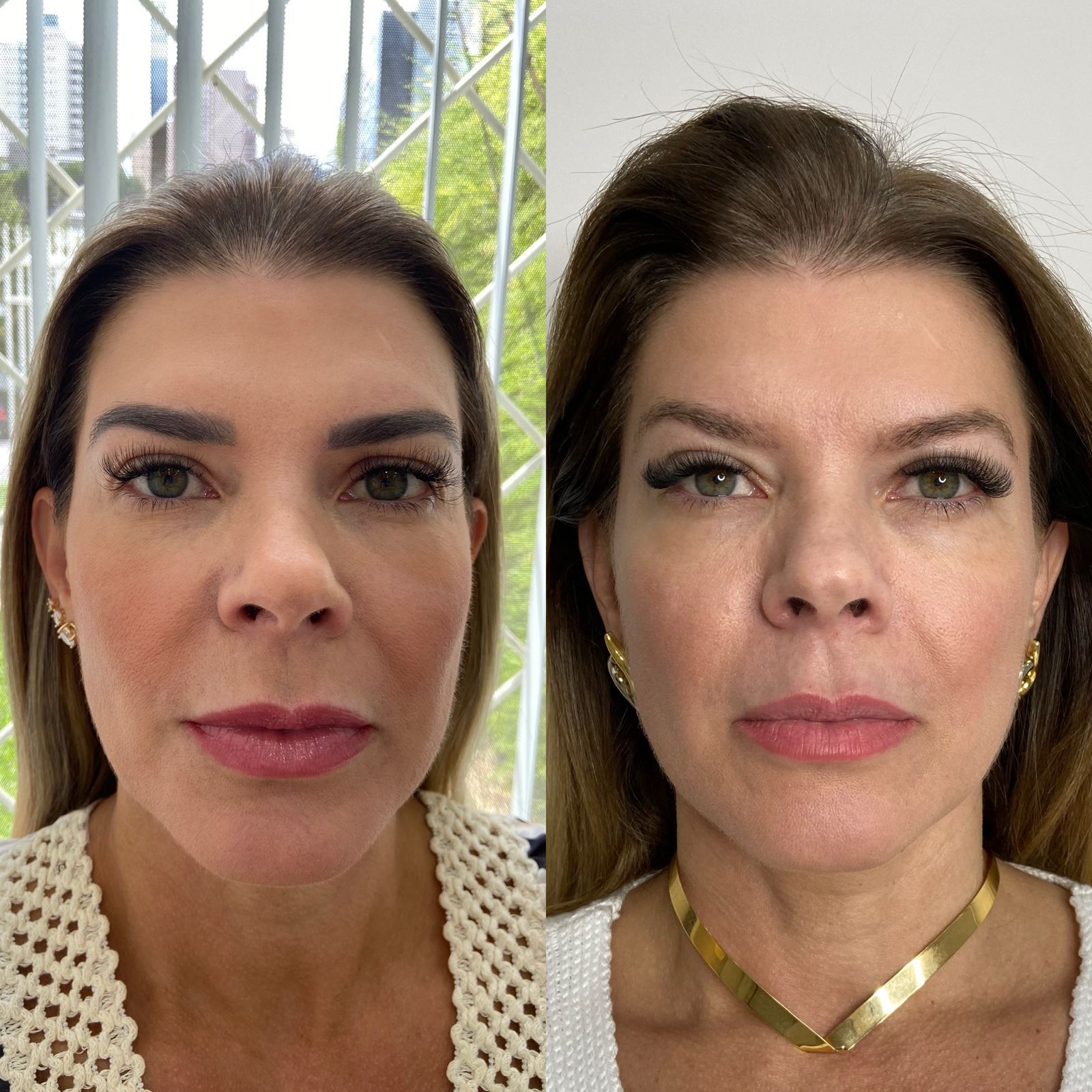 Antes e depois