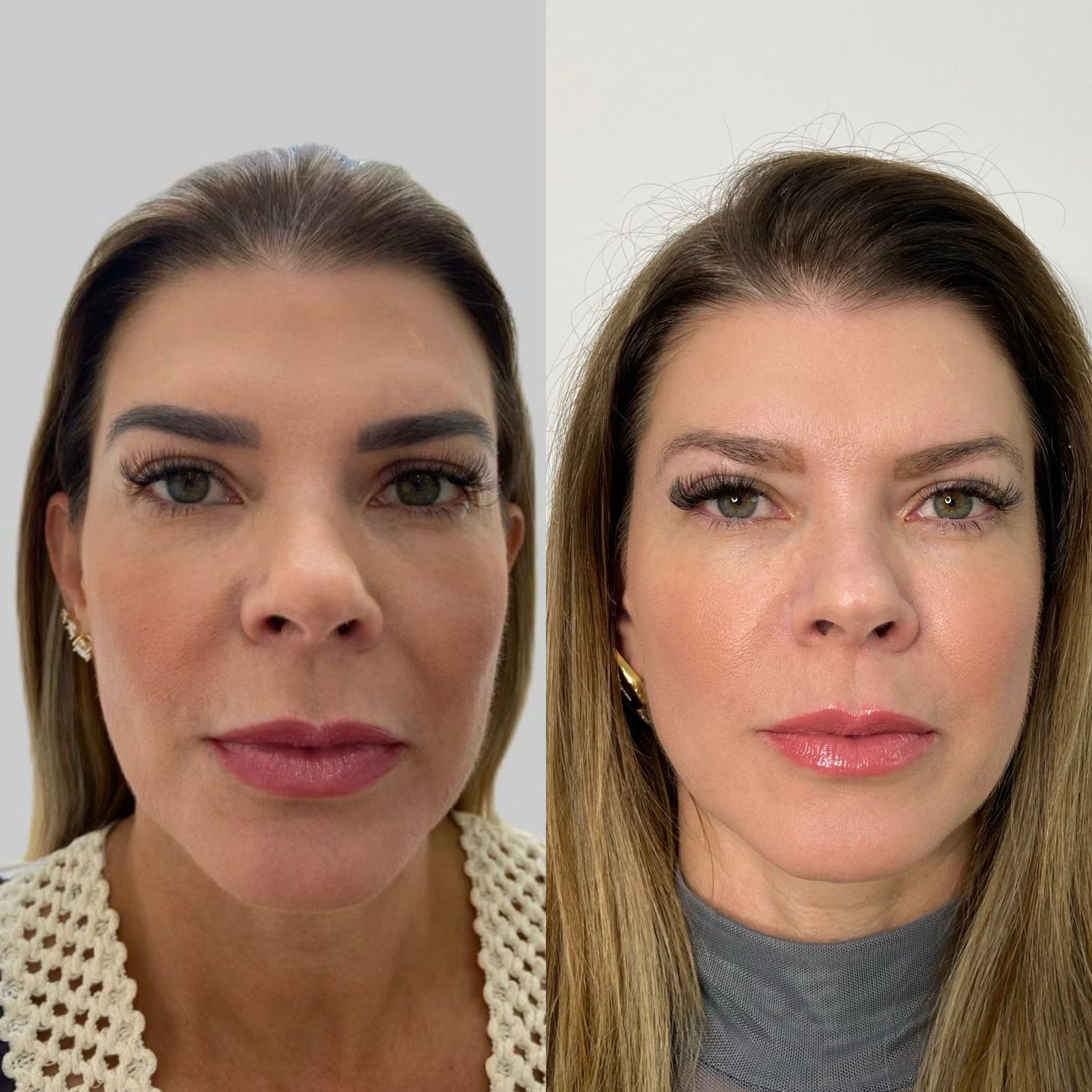 Antes e depois Bélla Natural