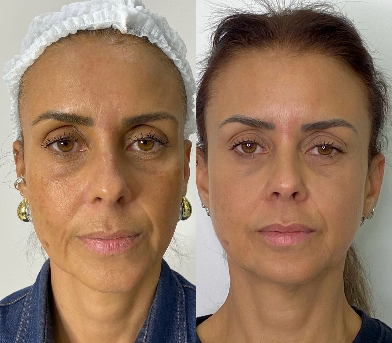 Antes e depois Bélla Natural