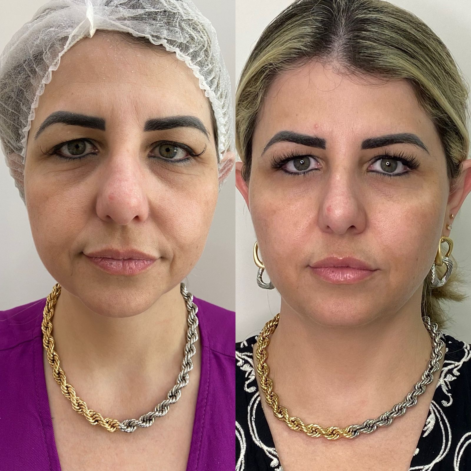 Antes e depois