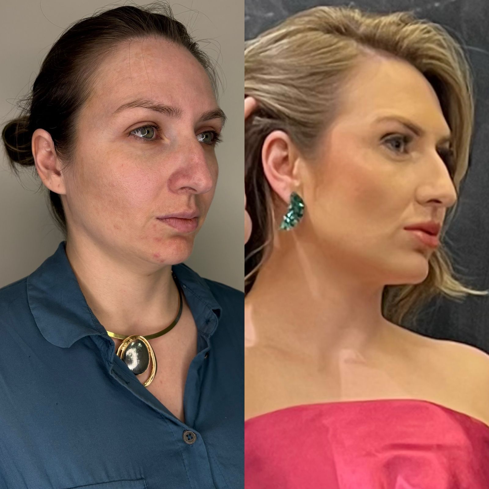 Antes e depois