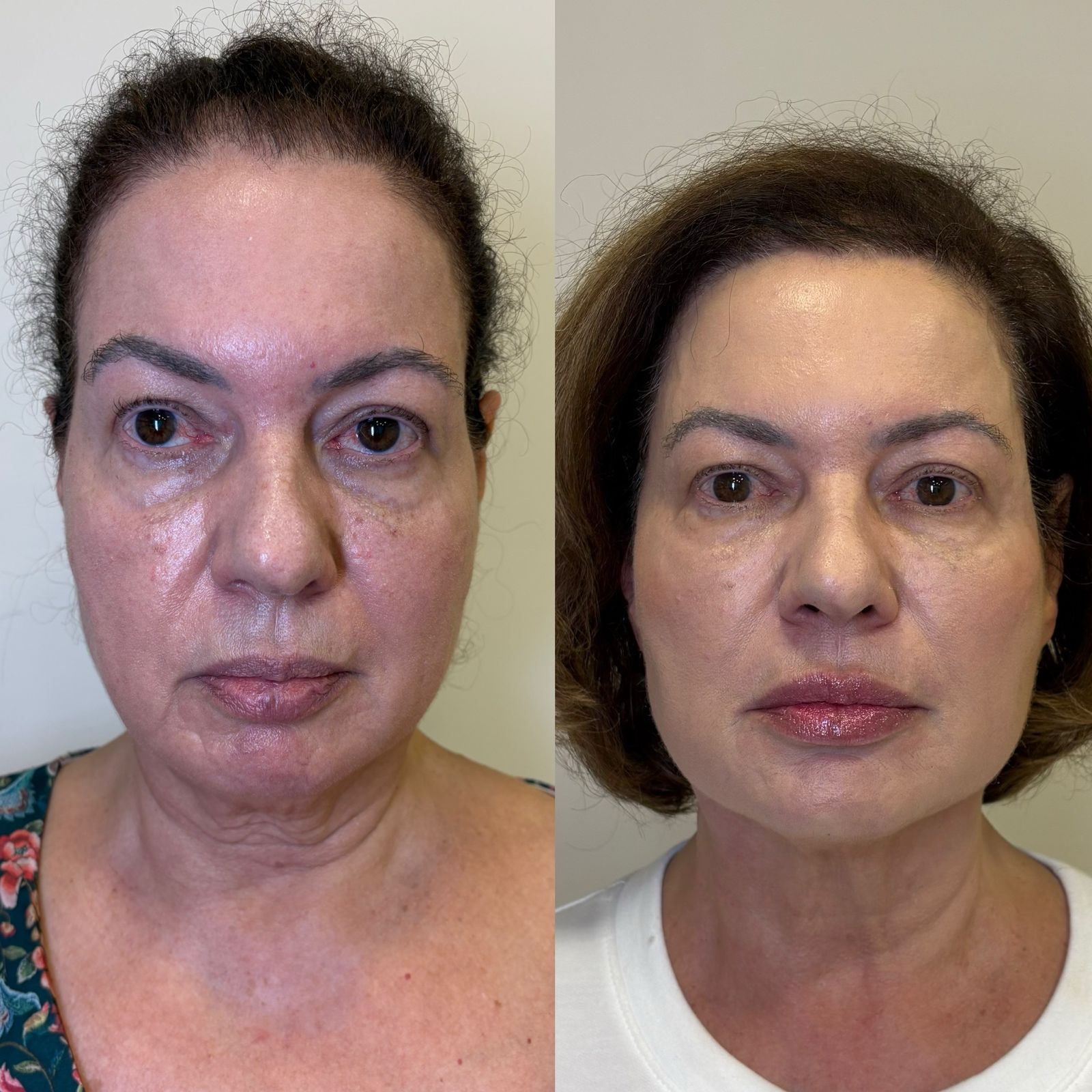Antes e depois