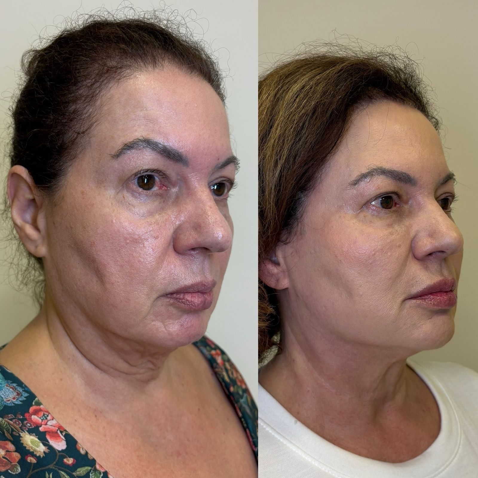 Antes e depois Bélla Natural