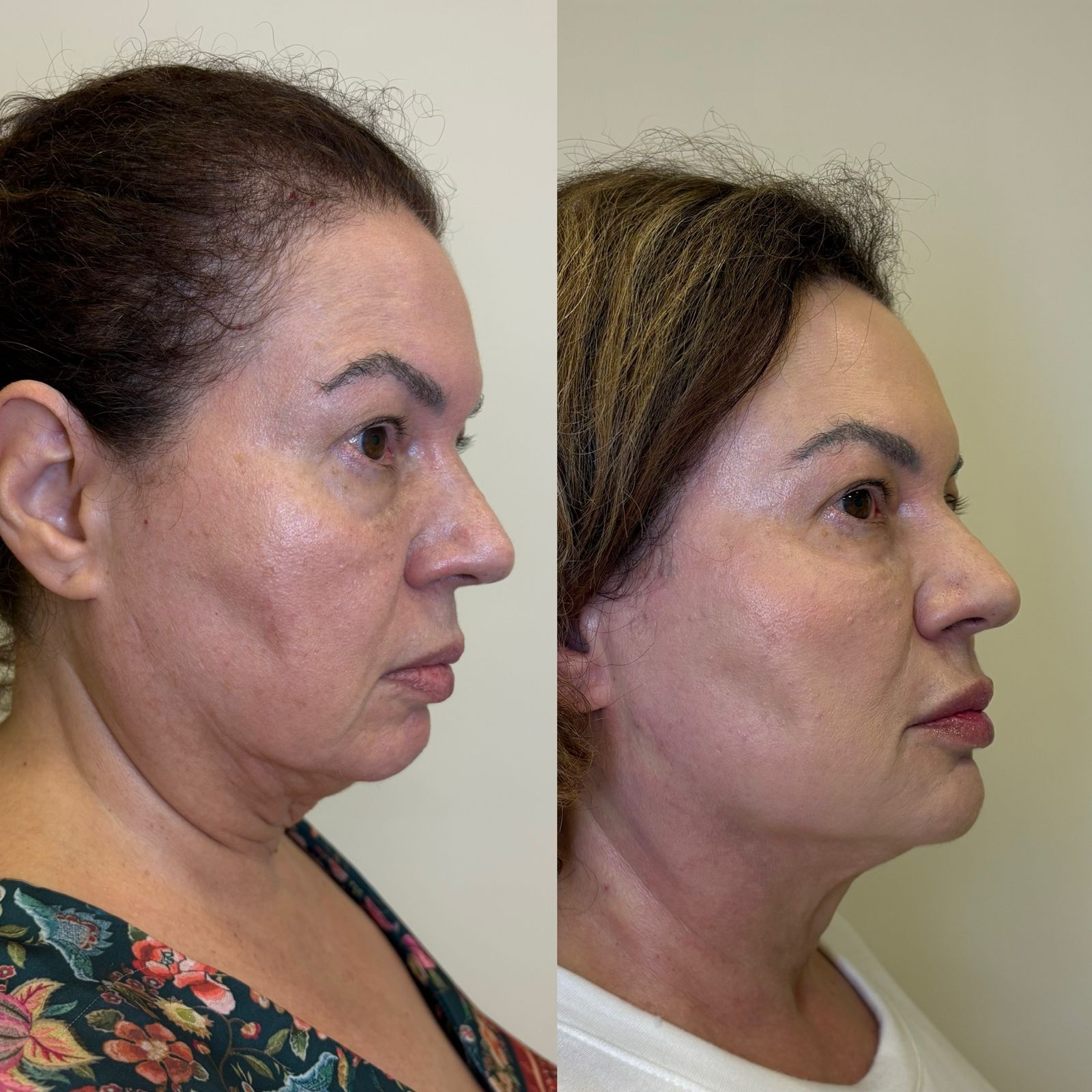 Antes e depois