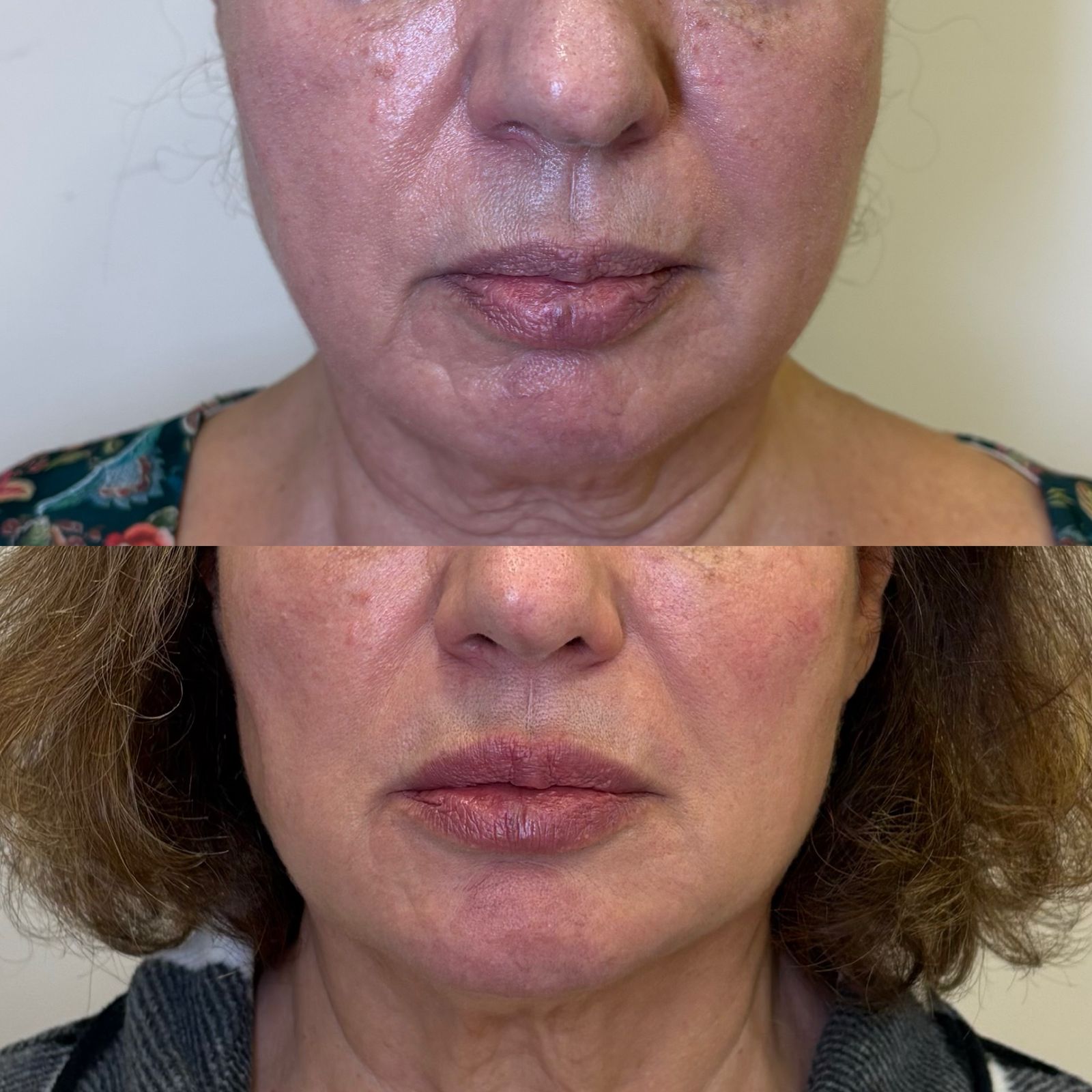Antes e depois Bélla Natural