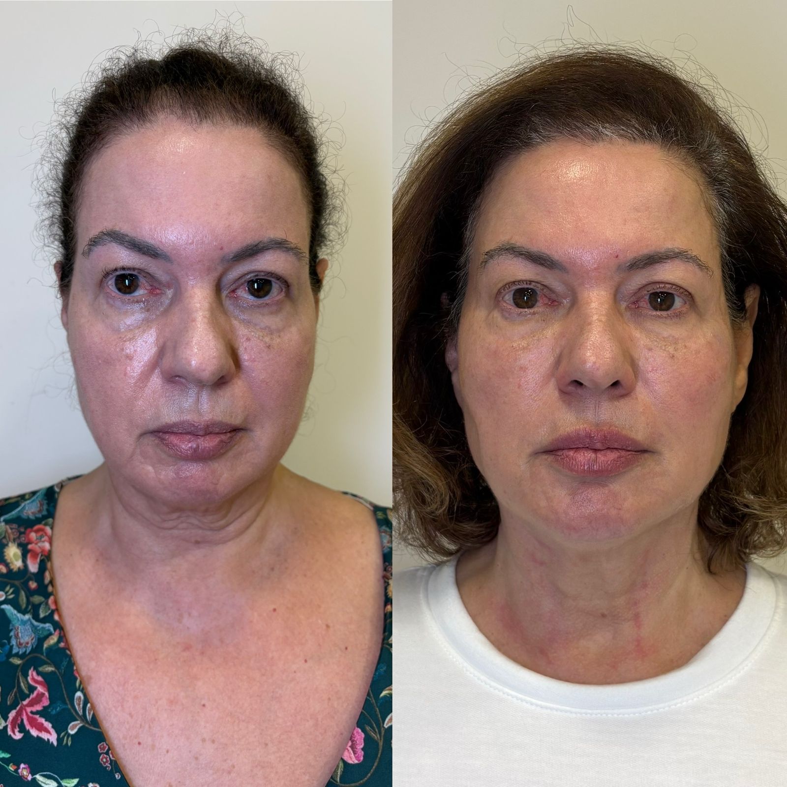 Antes e depois