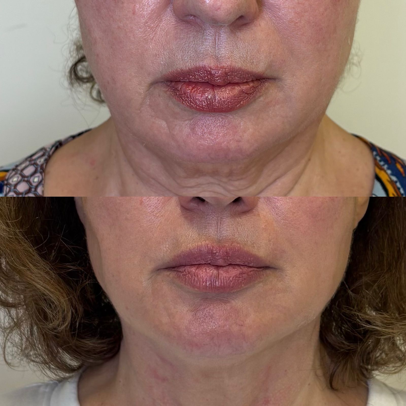 Antes e depois Bélla Natural