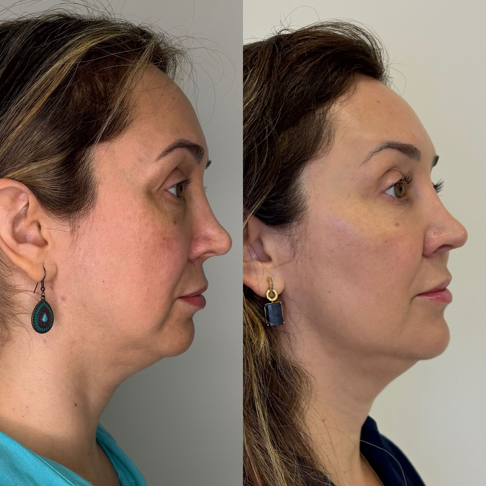 Antes e depois Bélla Natural