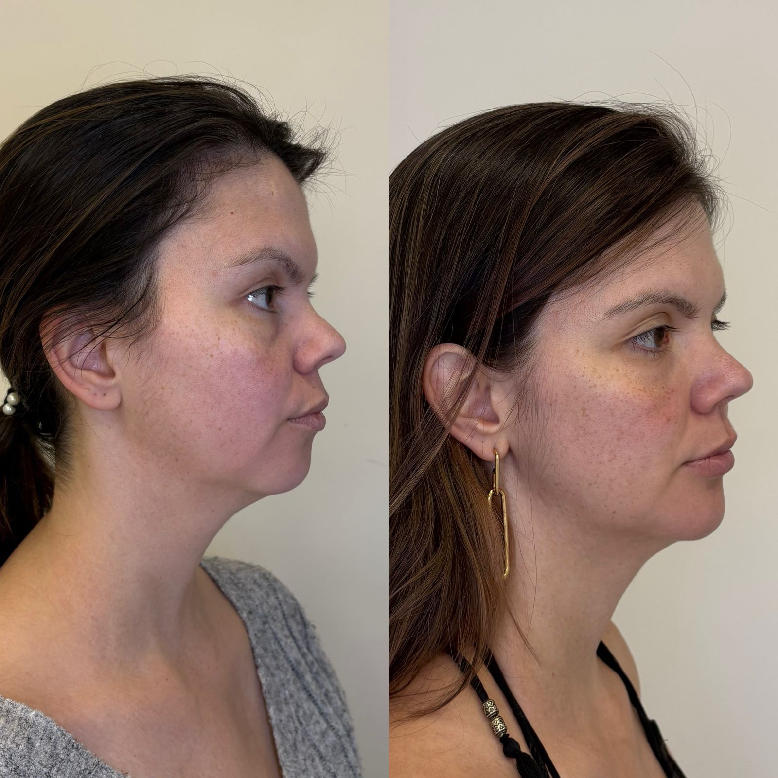 Antes e depois