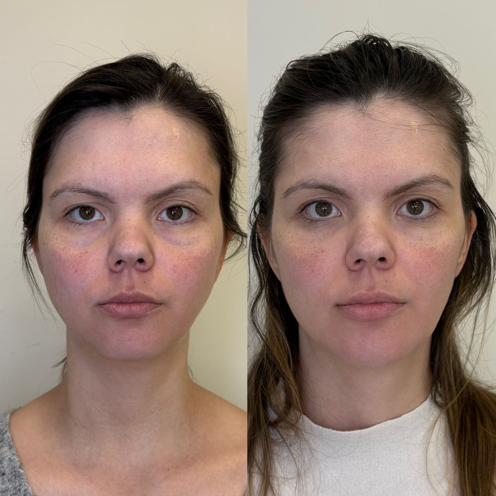 Antes e depois Bélla Natural